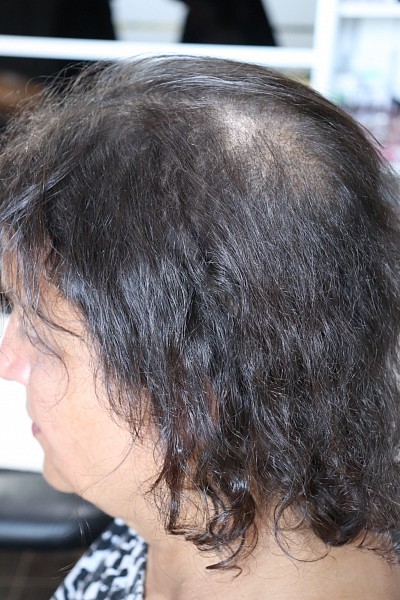 Densité du cuir chevelu